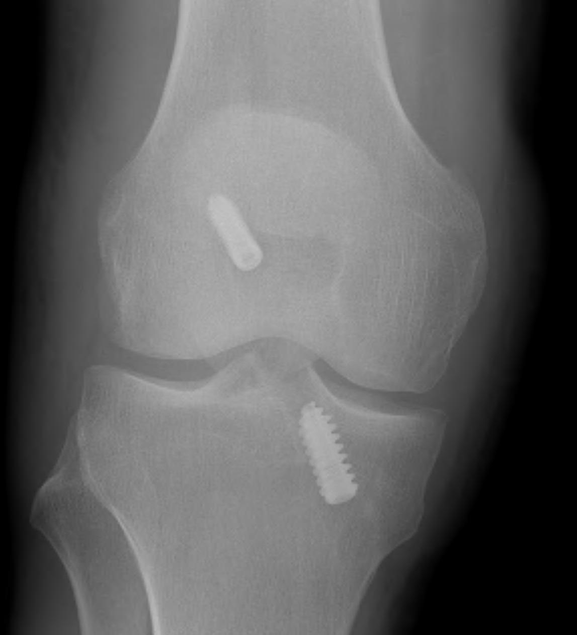 ACL BPTB Patella Fracture AP